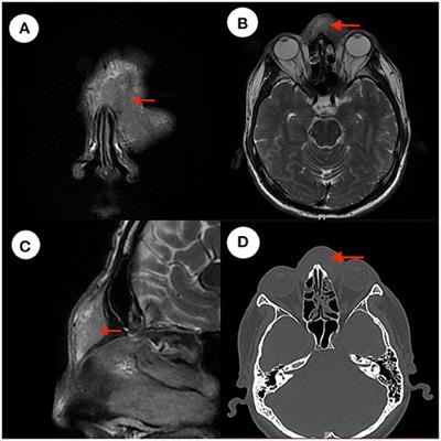 Case Report: A Rare Case of Nasal Forehead Mass in Kimura's Disease